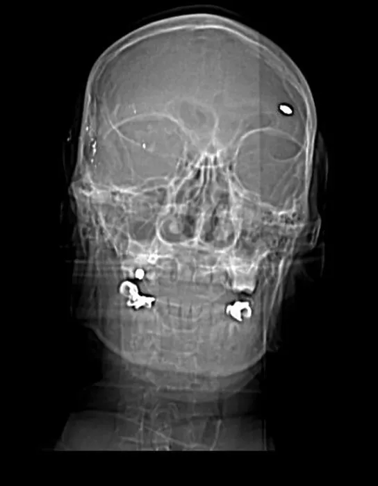 Framed Print : CT Scout View, Bullet Fragments Framed Print : CT Scout View, Bullet Fragments