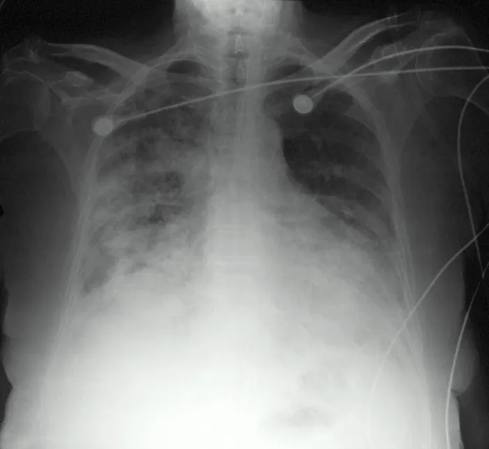 Framed Print : CXR congestive heart failure 77 year old woman Framed Print : CXR congestive heart failure 77 year old woman