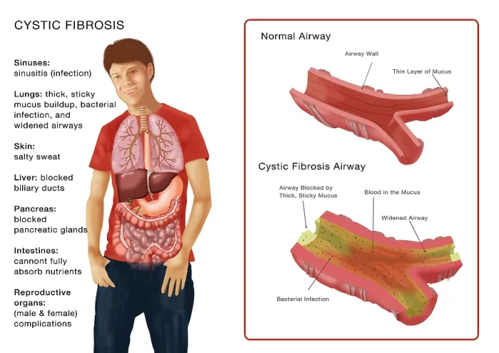 Framed Print : Cystic Fibrosis Framed Print : Cystic Fibrosis