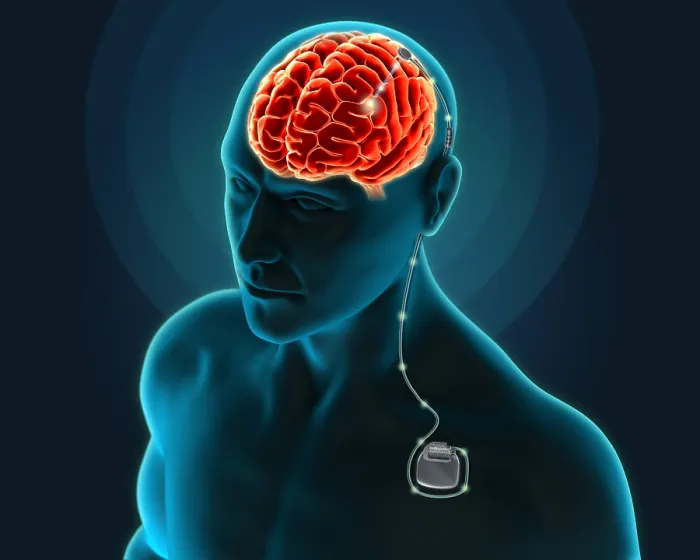 Framed Print : Deep Brain Stimulation, Illustration Framed Print : Deep Brain Stimulation, Illustration