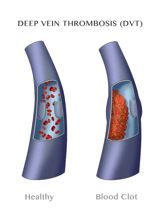Framed Print : Deep Vein Thrombosis, thrombophlebitis caused by a blood clot, medical Illustration Framed Print : Deep Vein Thrombosis, thrombophlebitis caused by a blood clot, medical Illustration