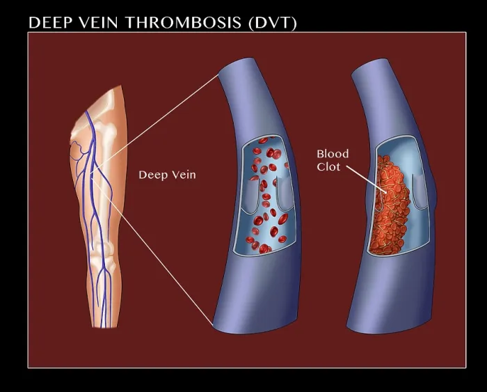 Framed Print : Deep Vein Thrombosis, thrombophlebitis caused by a blood clot in the leg, medical Illustration Framed Print : Deep Vein Thrombosis, thrombophlebitis caused by a blood clot in the leg, medical Illustration
