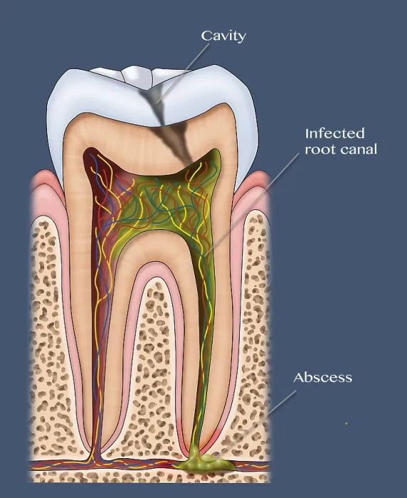 Framed Print : Dental Cavity and Abscess, tooth cross section of enamel, pulp, medical Illustration Framed Print : Dental Cavity and Abscess, tooth cross section of enamel, pulp, medical Illustration