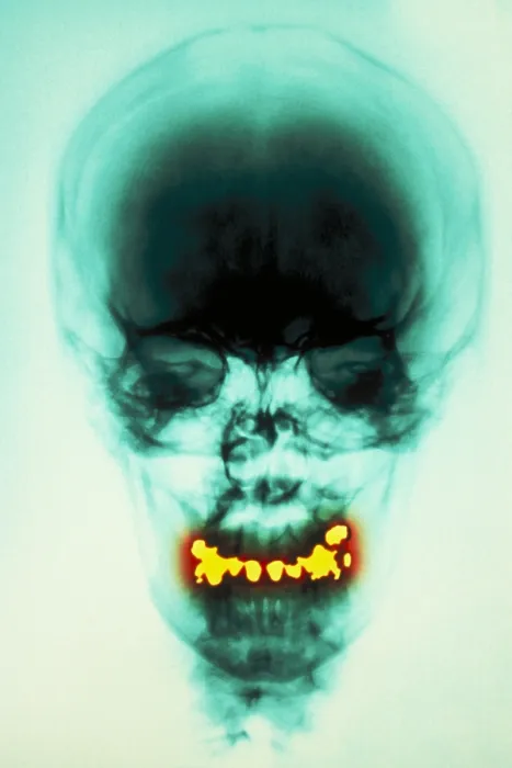 Framed Print : Dental fillings Framed Print : Dental fillings