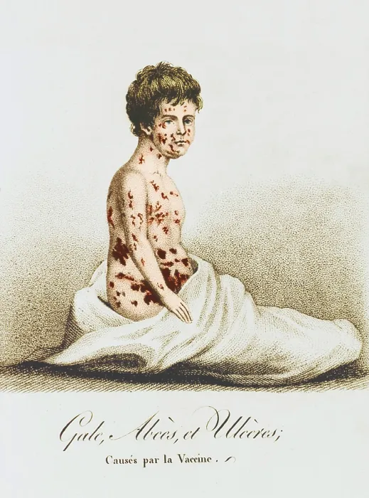 Framed Print : Development of Smallpox after Vaccination, 1807 Framed Print : Development of Smallpox after Vaccination, 1807