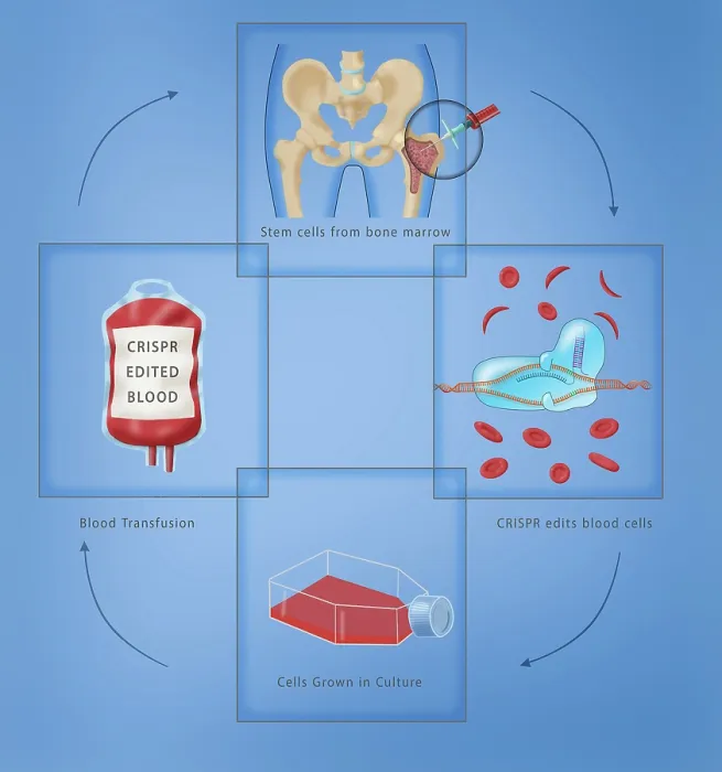 Framed Print : Diagram of CRISPR gene therapy as a Sickle Cell Anemia Disease cure through a transfusion, bone marrow aspiration, medical illustration Framed Print : Diagram of CRISPR gene therapy as a Sickle Cell Anemia Disease cure through a transfusion, bone marrow aspiration, medical illustration