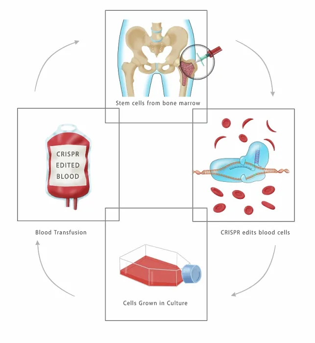 Framed Print : Diagram of CRISPR gene therapy as a Sickle Cell Anemia Disease cure through a transfusion, bone marrow aspiration, medical illustration Framed Print : Diagram of CRISPR gene therapy as a Sickle Cell Anemia Disease cure through a transfusion, bone marrow aspiration, medical illustration