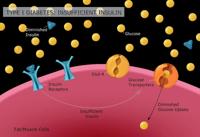 Framed Print : Diagram of type I diabetes, insulin, glucose, receptors, GLUT4 glucose transporters, medical illustration Framed Print : Diagram of type I diabetes, insulin, glucose, receptors, GLUT4 glucose transporters, medical illustration