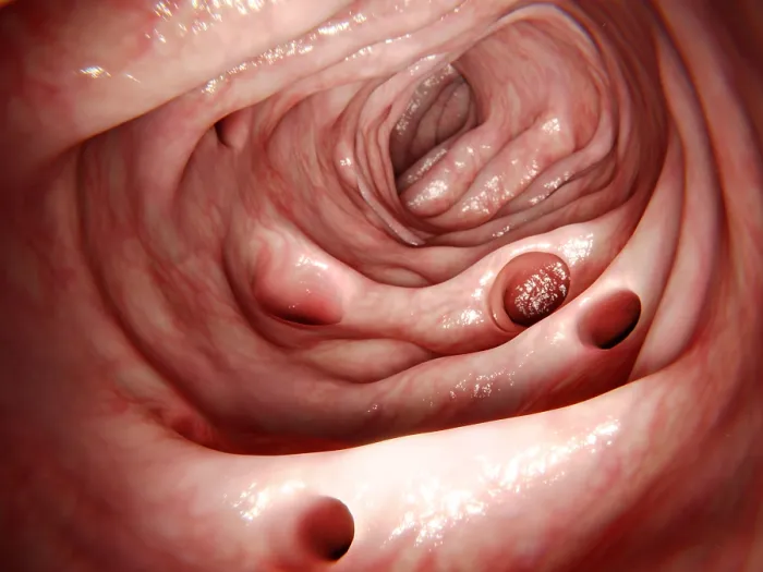 Framed Print : Diverticulosis Framed Print : Diverticulosis
