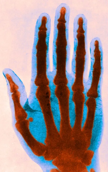 Framed Print : Early X-ray