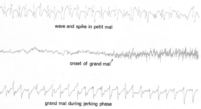 Framed Print : EEG of Epileptic Seizures