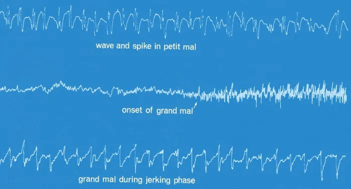Framed Print : EEG of Epileptic Seizures