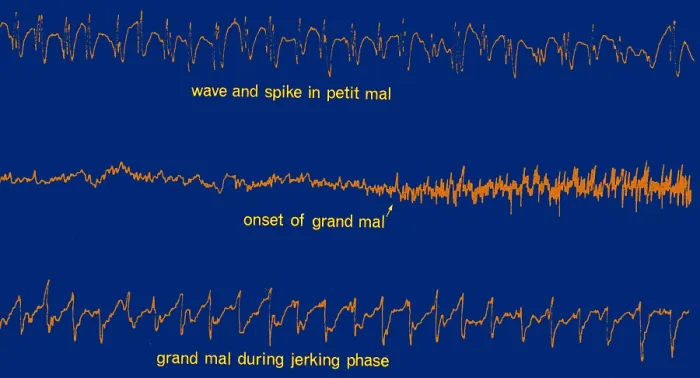 Framed Print : EEG of Epileptic Seizures Framed Print : EEG of Epileptic Seizures