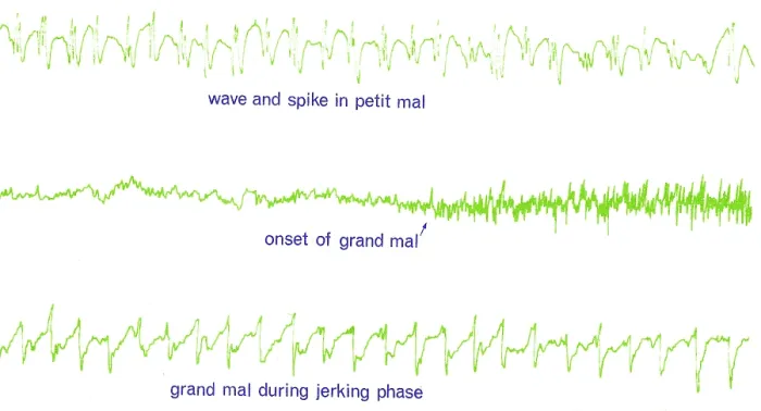 Framed Print : EEG of Epileptic Seizures Framed Print : EEG of Epileptic Seizures