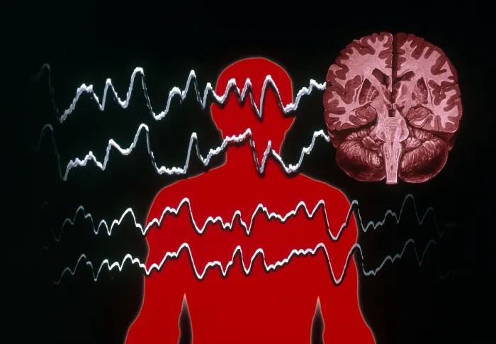 Framed Print : EEG of Tonic-clonic Seizure Framed Print : EEG of Tonic-clonic Seizure
