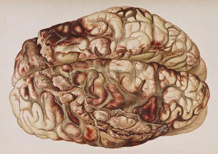 Framed Print : Encircling Gunshot-Wound in Brain, 1898 Framed Print : Encircling Gunshot-Wound in Brain, 1898