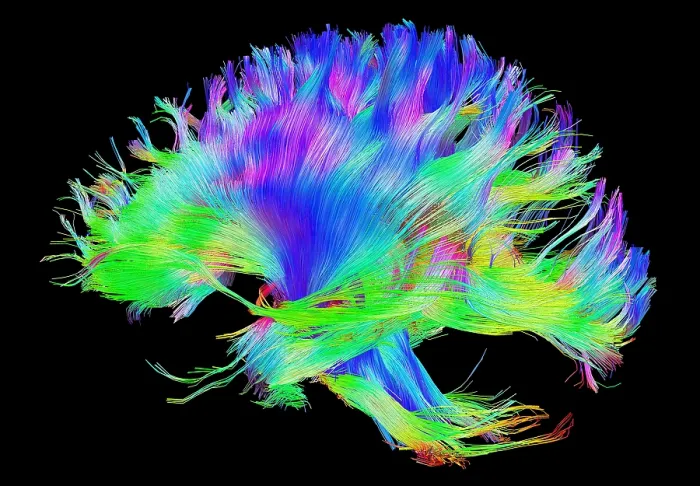 Framed Print : Fiber tracts of the brain, DTI Framed Print : Fiber tracts of the brain, DTI