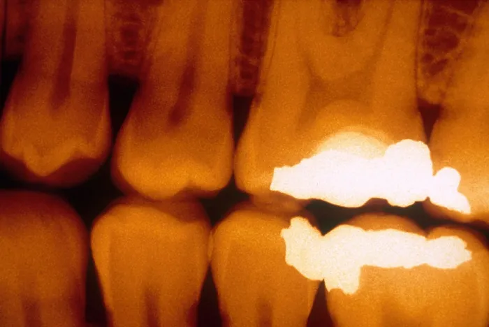 Framed Print : Fillings, X-ray Framed Print : Fillings, X-ray