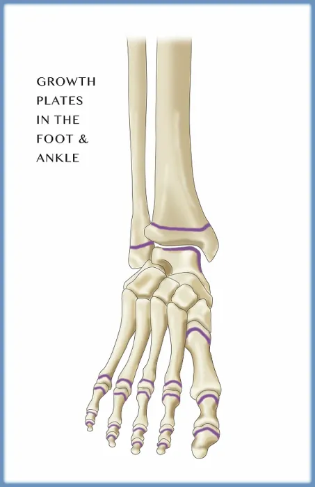 Framed Print : Foot Growth Plates, Illustration Framed Print : Foot Growth Plates, Illustration