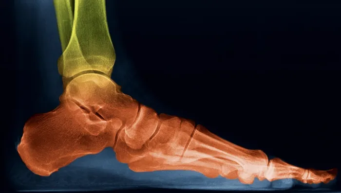 Framed Print : Foot X-Ray