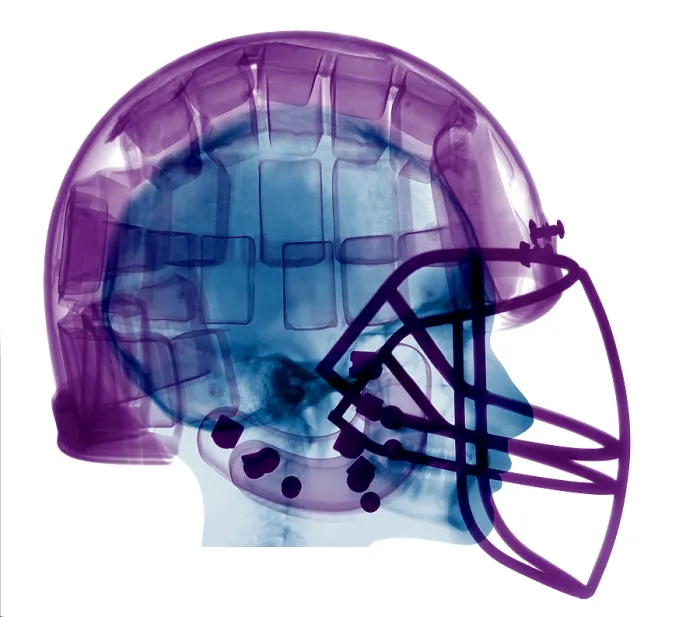 Framed Print : Football Helmet, X-Ray Framed Print : Football Helmet, X-Ray