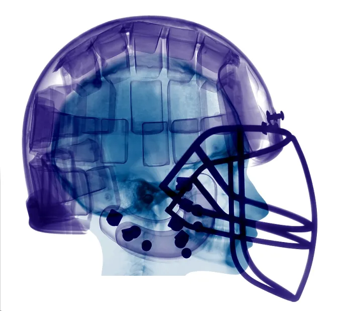 Framed Print : Football Helmet, X-Ray Framed Print : Football Helmet, X-Ray