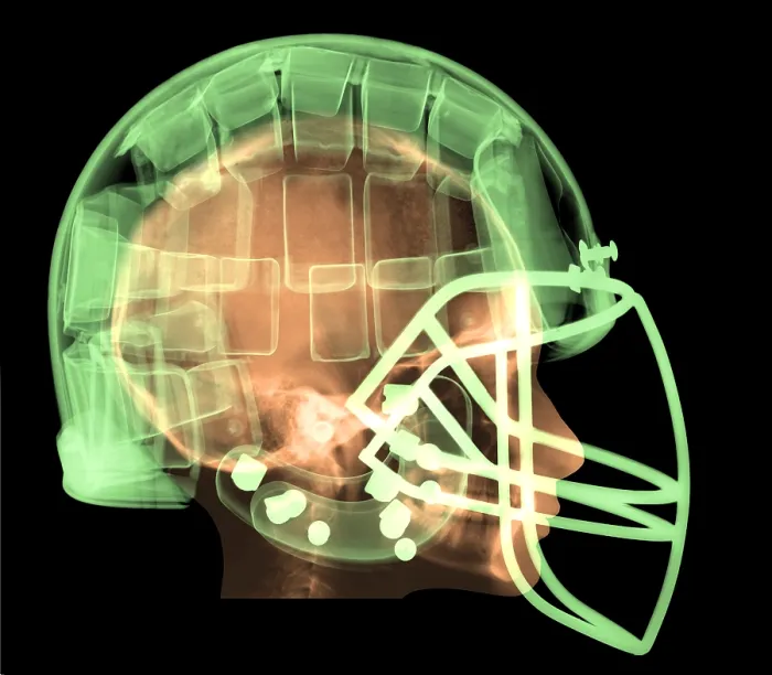 Framed Print : Football Helmet, X-Ray Framed Print : Football Helmet, X-Ray