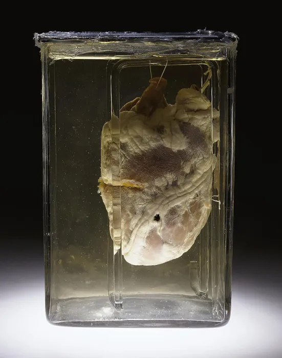 Framed Print : Forensic Evidence, Heart Perforated by Bullet, 1937 Framed Print : Forensic Evidence, Heart Perforated by Bullet, 1937