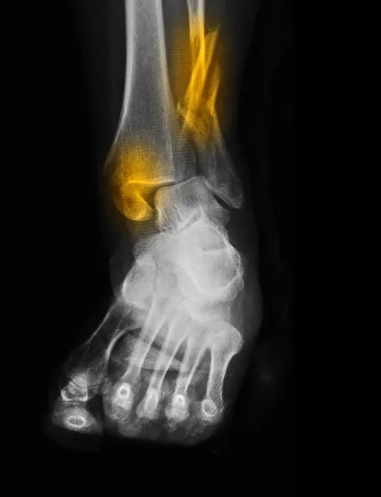 Framed Print : Fractured and Dislocated Ankle Framed Print : Fractured and Dislocated Ankle
