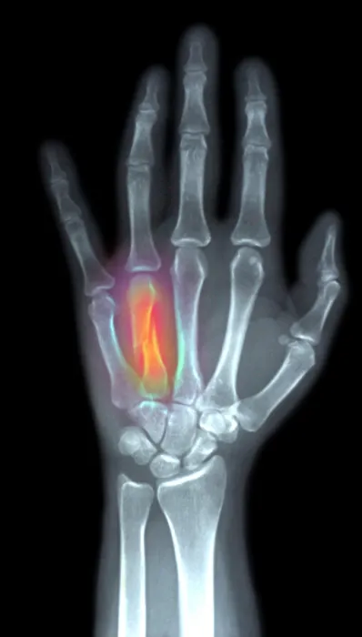 Framed Print : Fractured Metacarpal Framed Print : Fractured Metacarpal