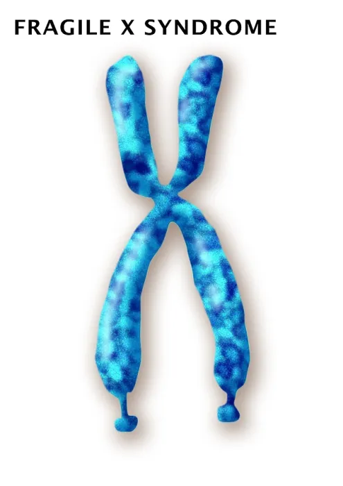 Framed Print : Fragile X Syndrome (FXS) is a genetic condition often associated with autism spectrum disorder (ASD), illustration Framed Print : Fragile X Syndrome (FXS) is a genetic condition often associated with autism spectrum disorder (ASD), illustration