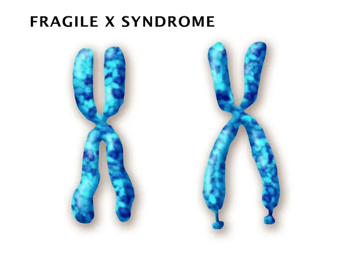 Framed Print : Fragile X Syndrome (FXS) is a genetic condition often associated with autism spectrum disorder (ASD), illustration