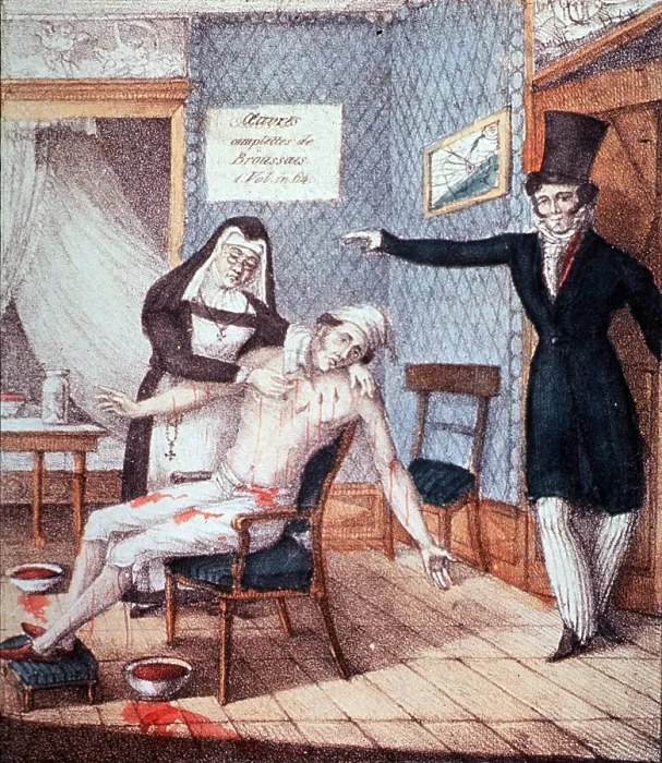 Framed Print : Francois Joseph Victor Broussais, French Physician Framed Print : Francois Joseph Victor Broussais, French Physician