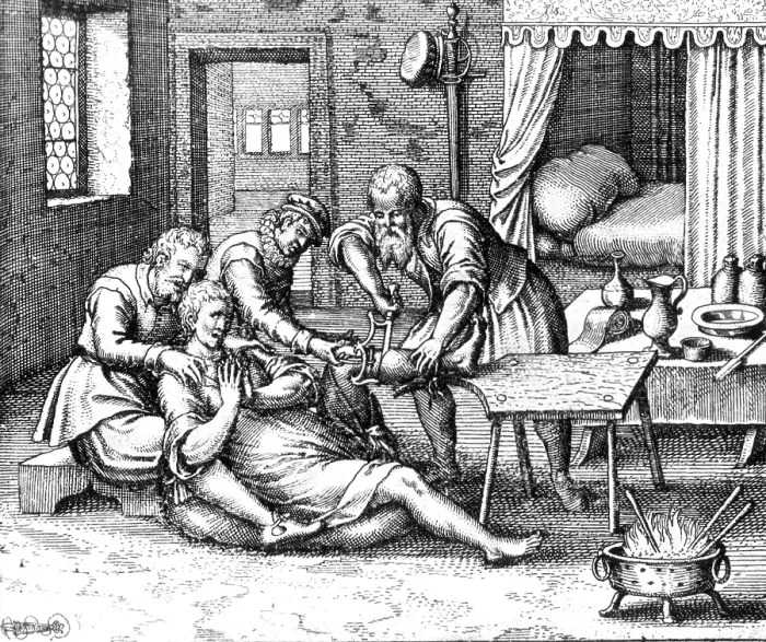 Framed Print : Gangrene Amputation of Leg, 17th Century Framed Print : Gangrene Amputation of Leg, 17th Century