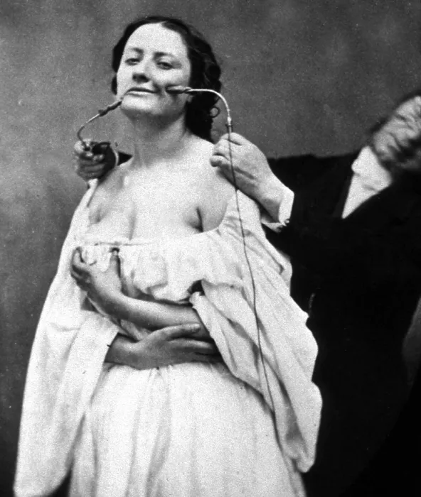 Framed Print : G.B.A. Duchenne Performs Electrotherapy, 1862