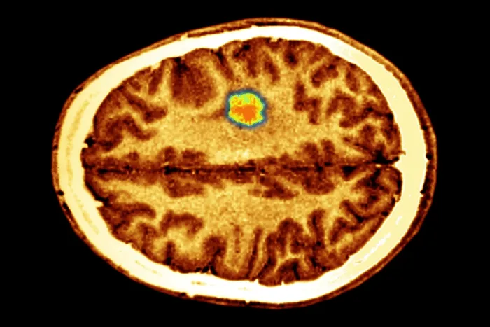 Framed Print : Glioma brain tumor Framed Print : Glioma brain tumor