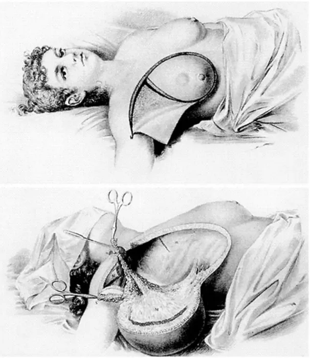 Framed Print : Halsted Radical Mastectomy, 1882