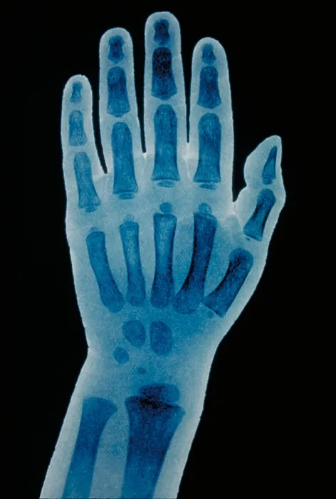 Framed Print : Hand x-ray of a 2 year old child Framed Print : Hand x-ray of a 2 year old child