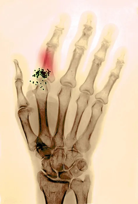 Framed Print : Hand x-ray showing shotgun wound Framed Print : Hand x-ray showing shotgun wound