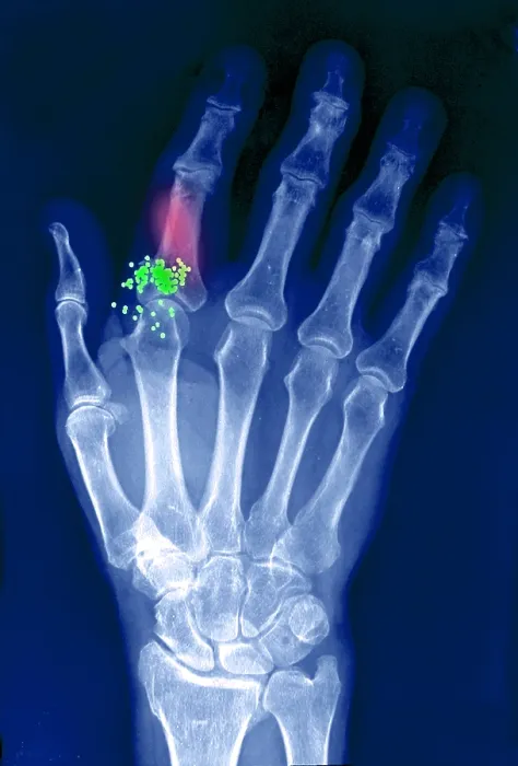 Framed Print : Hand x-ray showing shotgun wound Framed Print : Hand x-ray showing shotgun wound