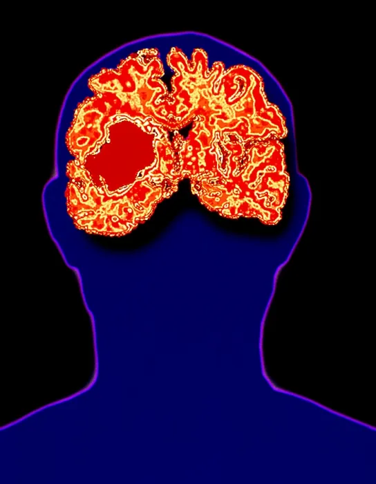 Framed Print : Head showing brain hemorrhage Framed Print : Head showing brain hemorrhage