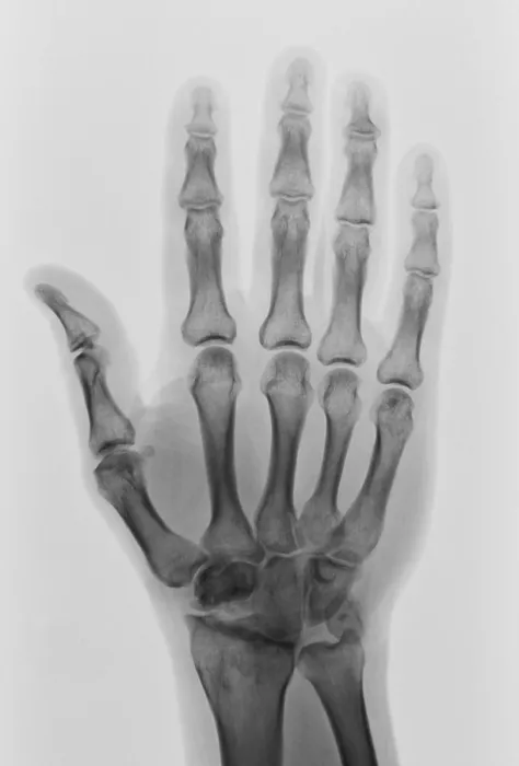 Framed Print : Healthy Hand X-ray Framed Print : Healthy Hand X-ray
