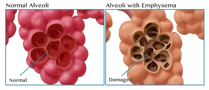Framed Print : Healthy vs. Emphysematous Alveoli Framed Print : Healthy vs. Emphysematous Alveoli