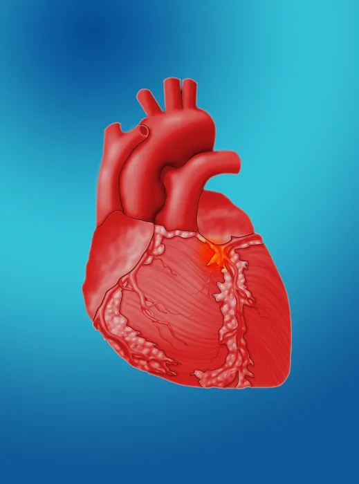 Framed Print : Heart Attack, Conceptual Illustration Framed Print : Heart Attack, Conceptual Illustration