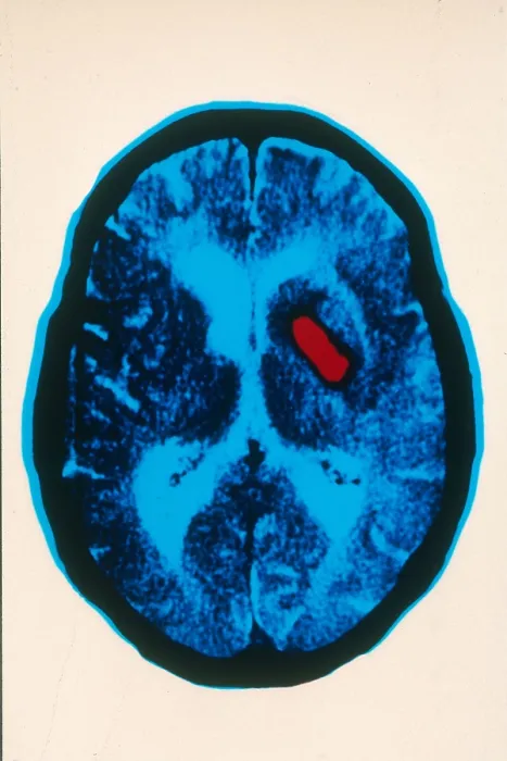 Framed Print : Hemorrhagic stroke, CT Scan Framed Print : Hemorrhagic stroke, CT Scan
