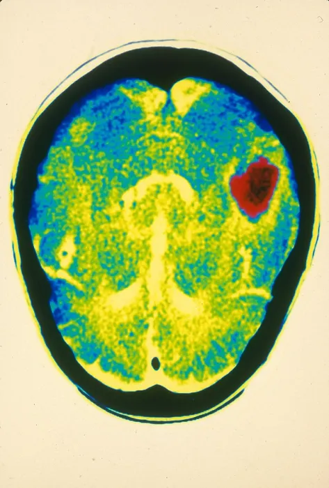 Framed Print : Hemorrhagic stroke, CT Scan Framed Print : Hemorrhagic stroke, CT Scan