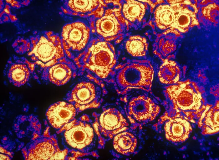 Framed Print : Herpes Simplex Virus (TEM)