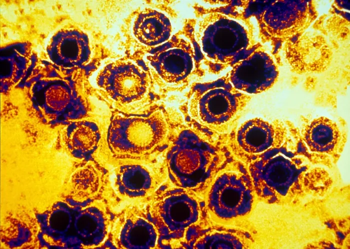 Framed Print : Herpes Simplex Virus (TEM) Framed Print : Herpes Simplex Virus (TEM)