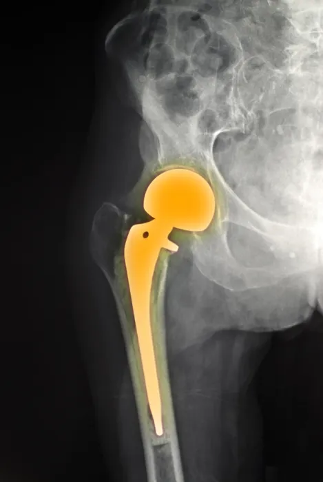 Framed Print : Hip Fracture with Prosthesis Framed Print : Hip Fracture with Prosthesis