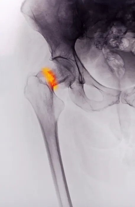 Framed Print : Hip Fracture X-Ray